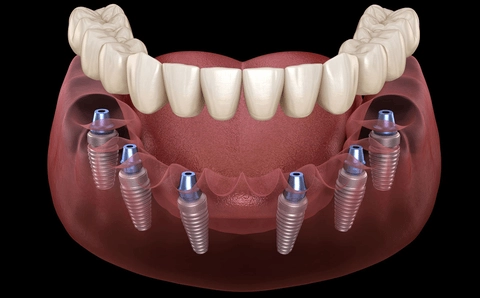 Dental Implantology