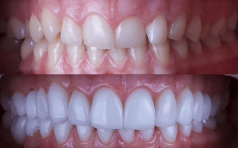 Emax Veneers